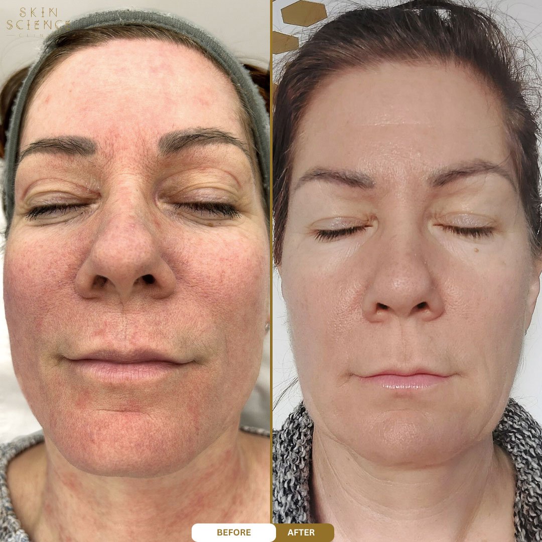 Zoey before and after BBL and MOXI treatment — front view