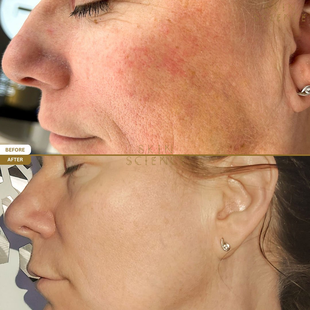 Zoey before and after BBL and MOXI treatment — side profile