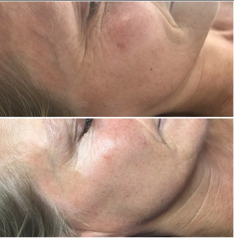 Before and after an ageing treatment with phototherapy at Skin Science Clinic in London