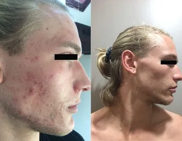 Before and after an ageing treatment with phototherapy on a young male