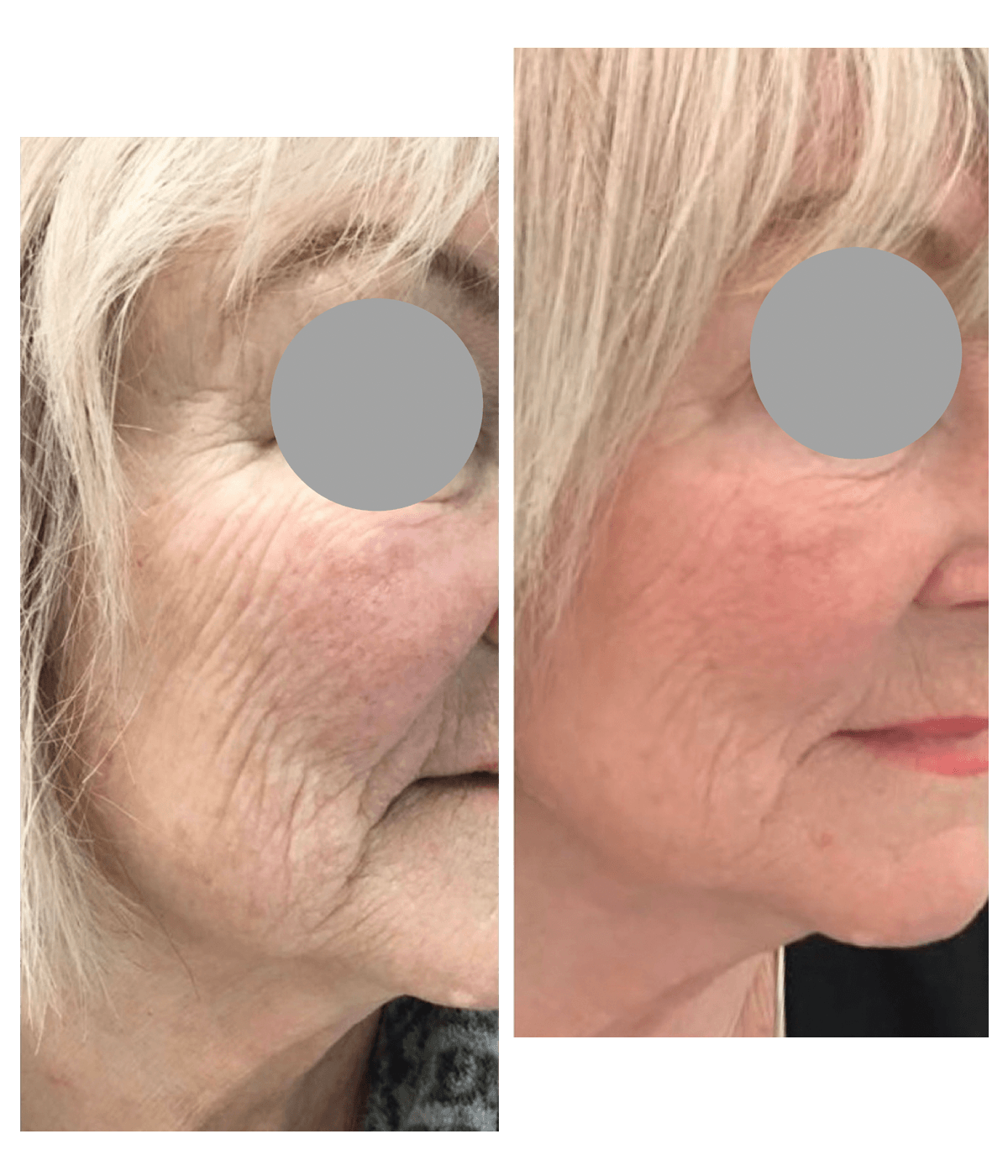 Before and after polynucleotide treatment in the under-eye and cheek area