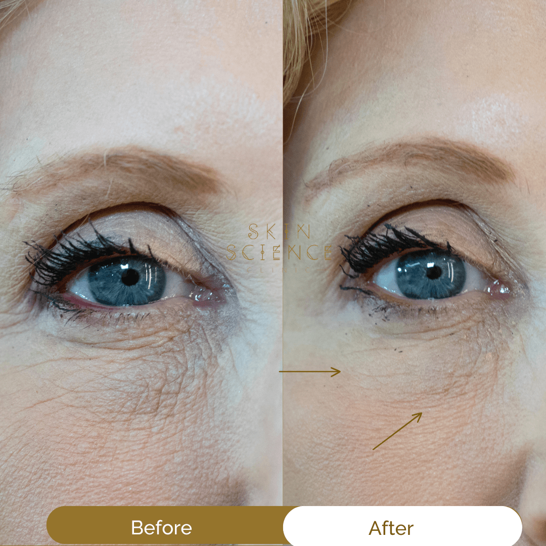 Before and after polynucleotide treatment under the eyes