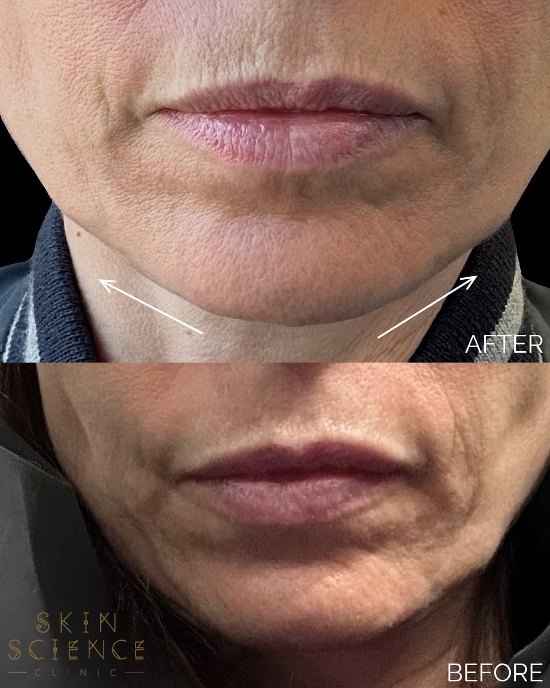 Before and after Profhilo Structura at Skin Science Clinic