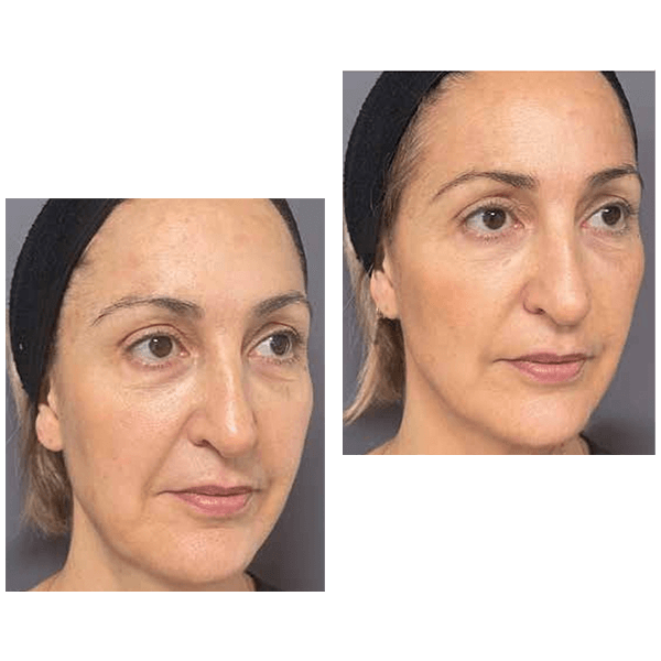 Profhilo Structura — face before and after
