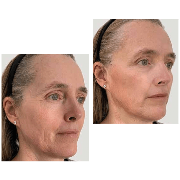 Profhilo Structura — before and after