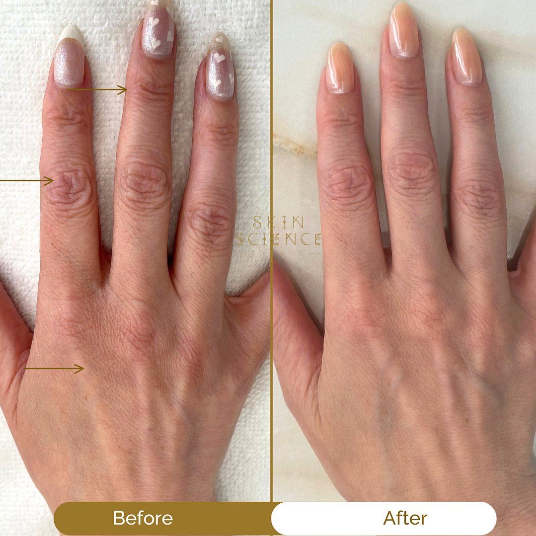 Before and after Profhilo injections in the hand