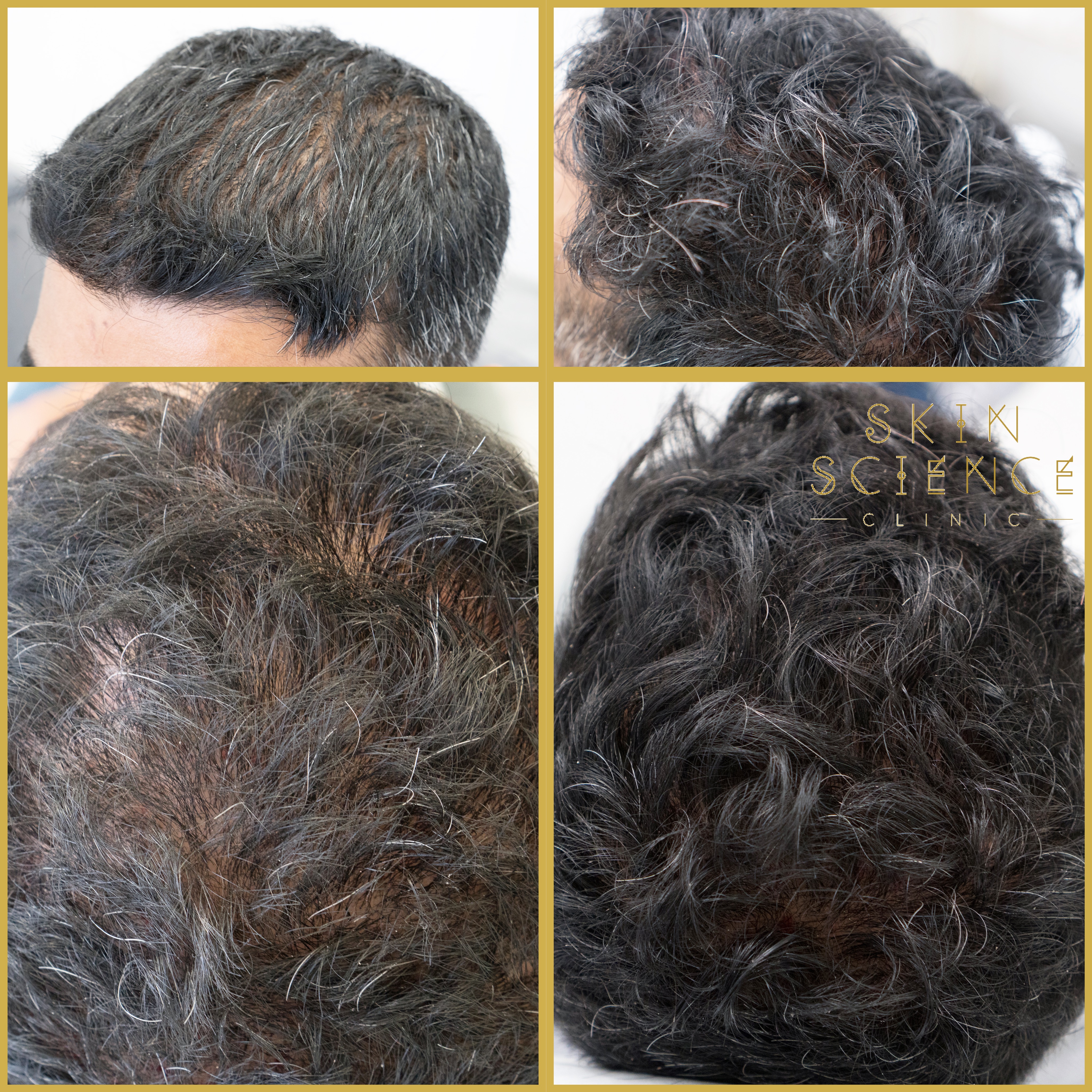 Before and after PRP for hair