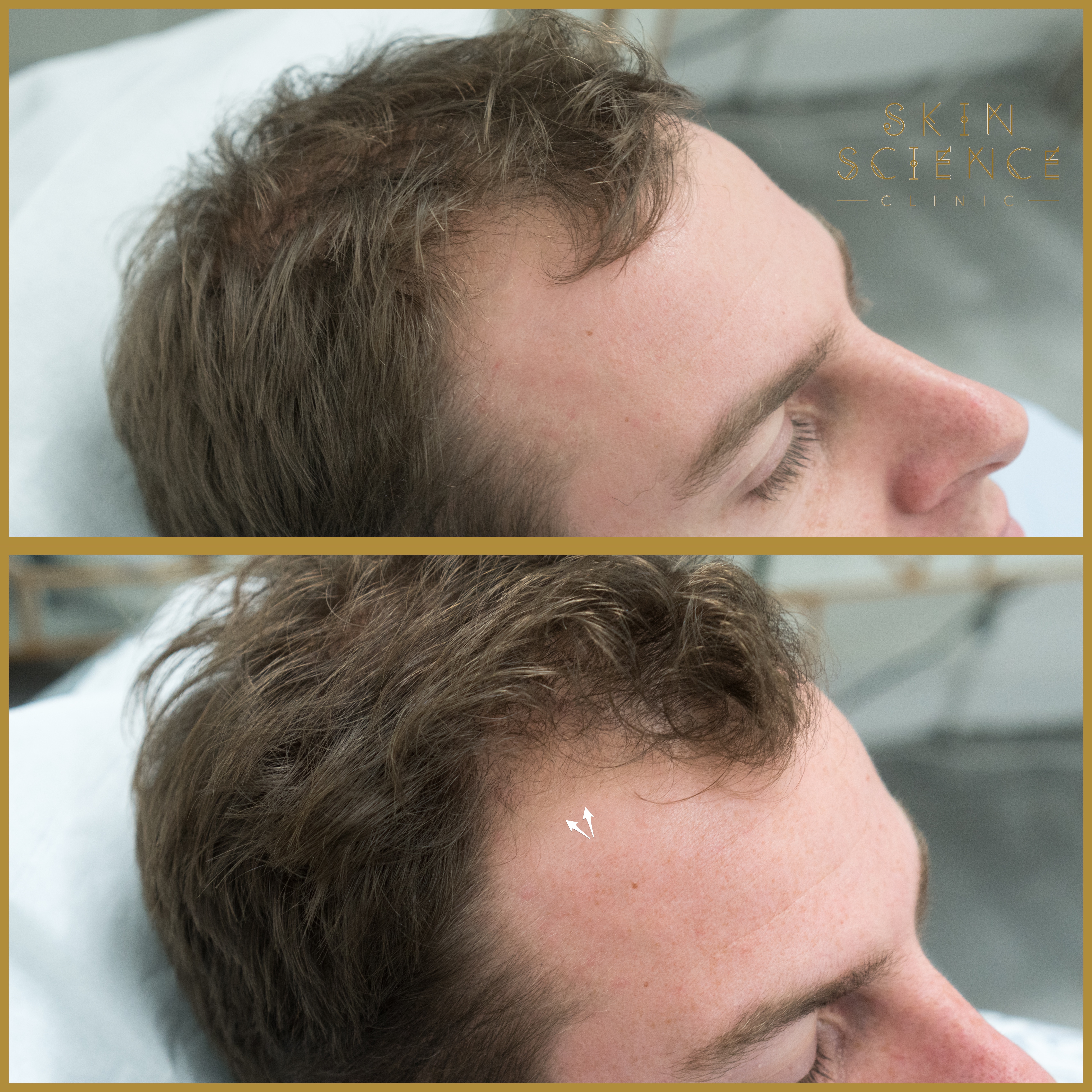 Before and after PRP for hair — one session