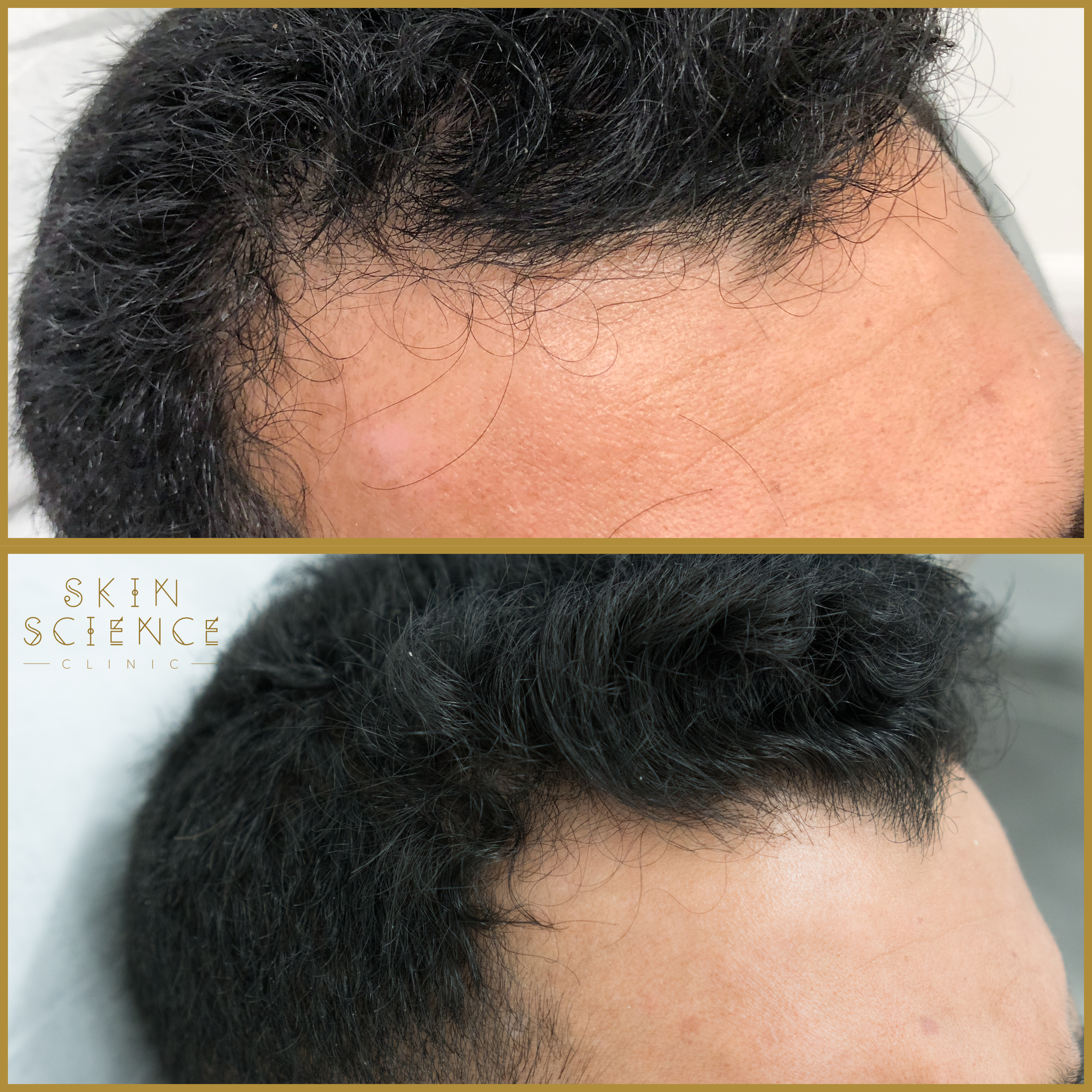 Before and after PRP for hair — two treatments