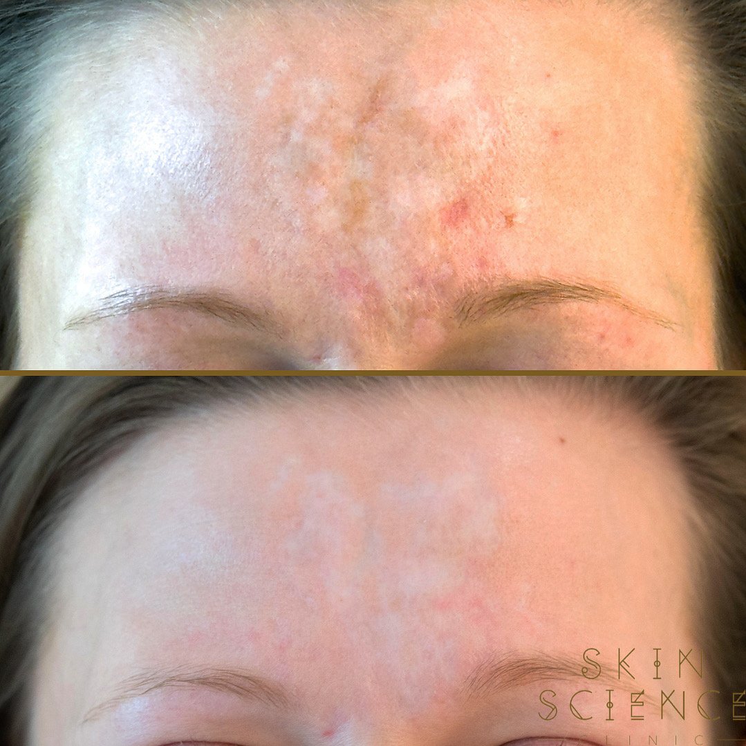 Before and after RF microneedling at Skin Science Clinic in London