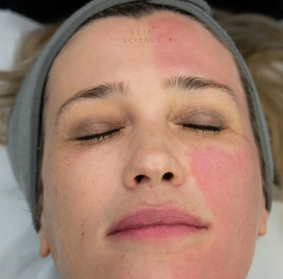 RF microneedling treatment now at Skin Science Clinic in London