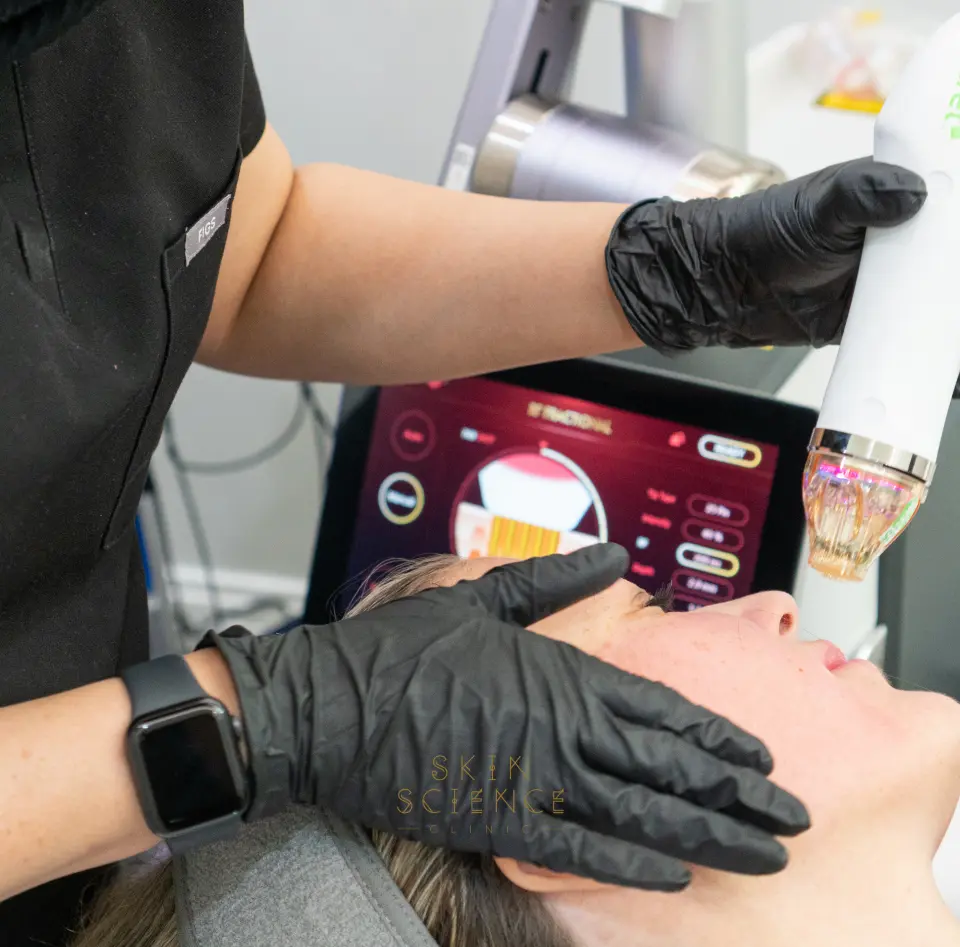 Inotive RF microneedling treatment London