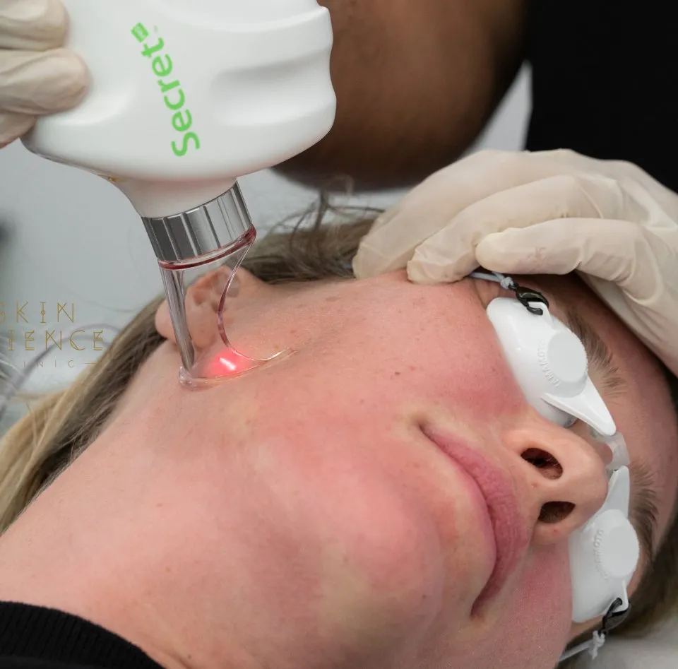 The microneedling RF Secret procedure