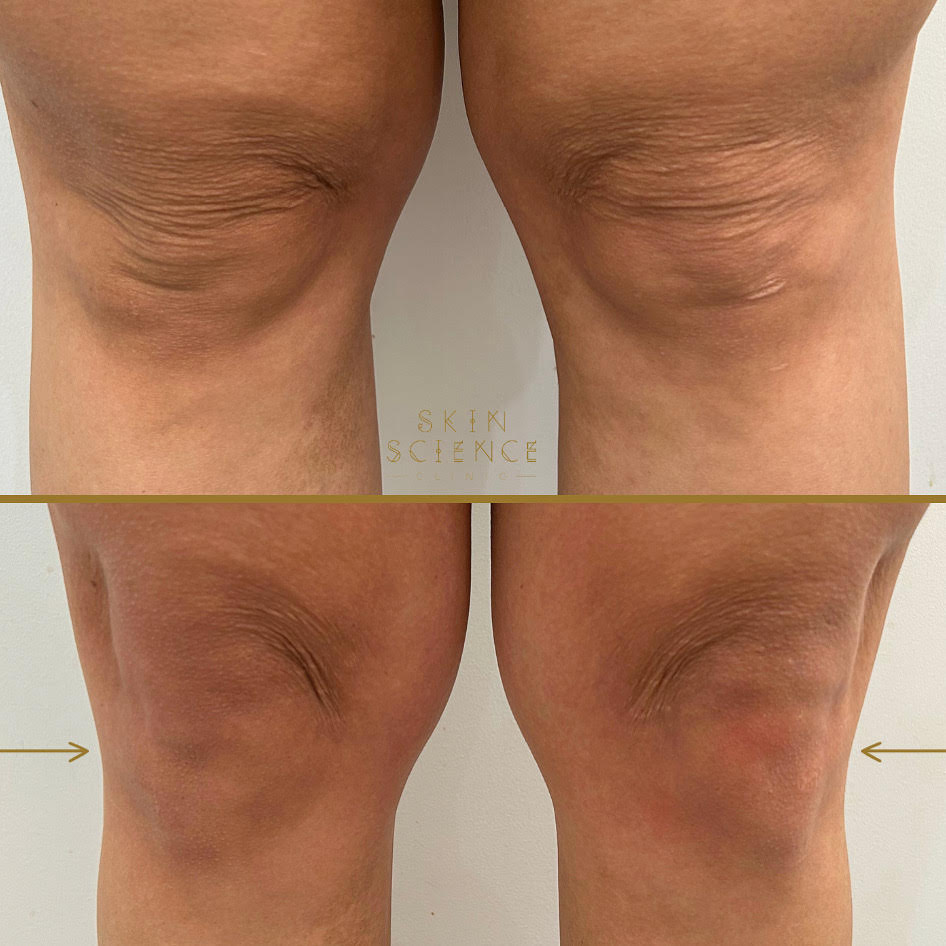 Before and after SkinTyte treatment on a knee at Skin Science Clinic in London
