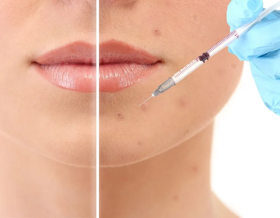Spot injection on the chin at Skin Science Clinic in London