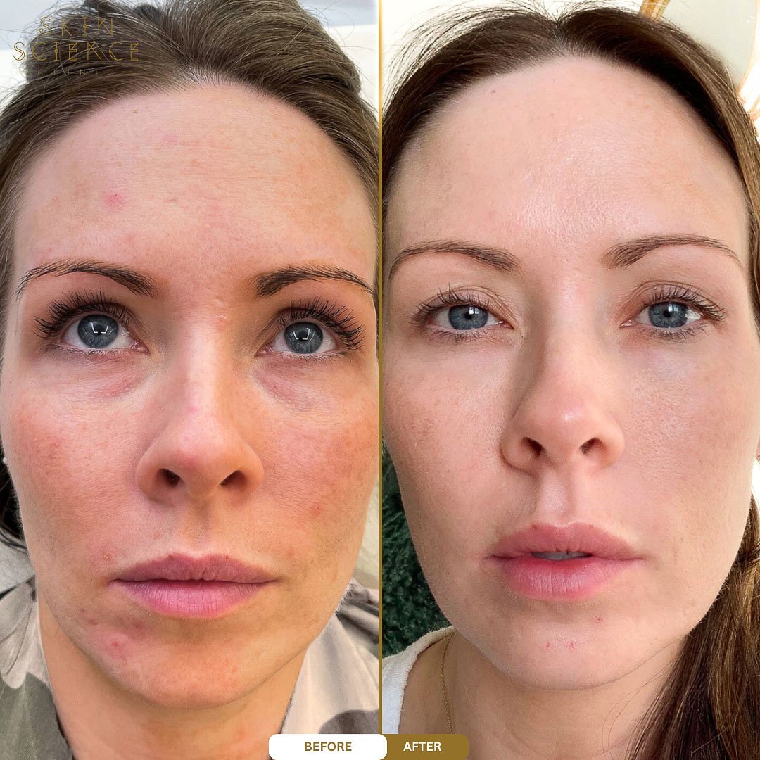 Before and after a VI Peel at Skin Science Clinic