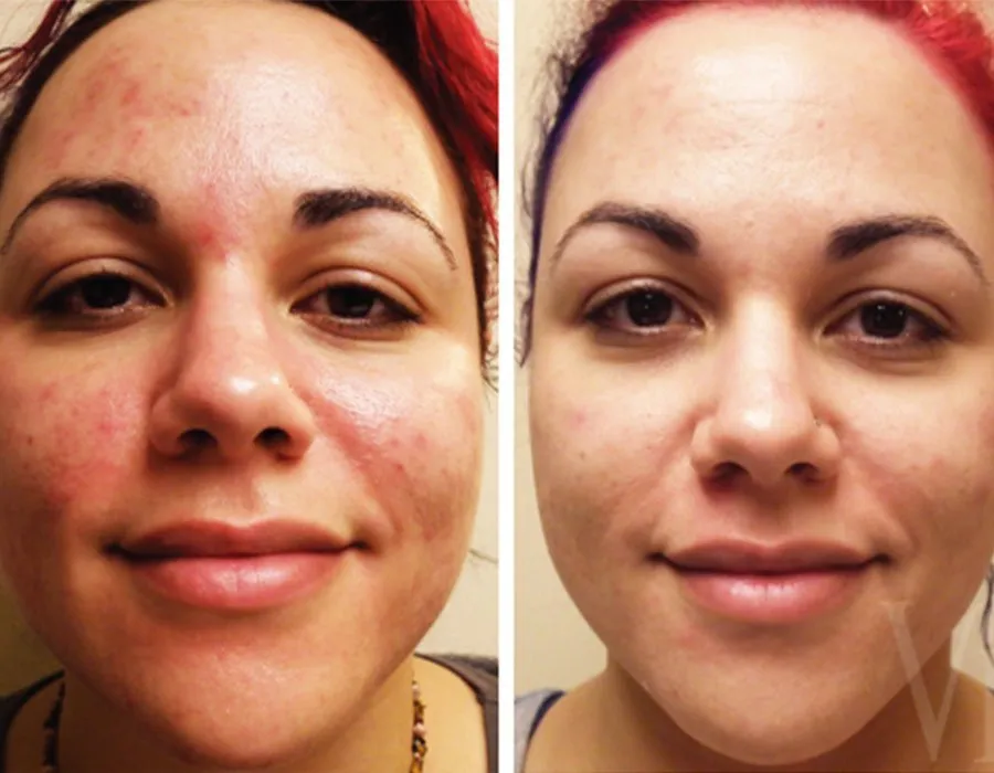 VI Peel before and after on a young woman