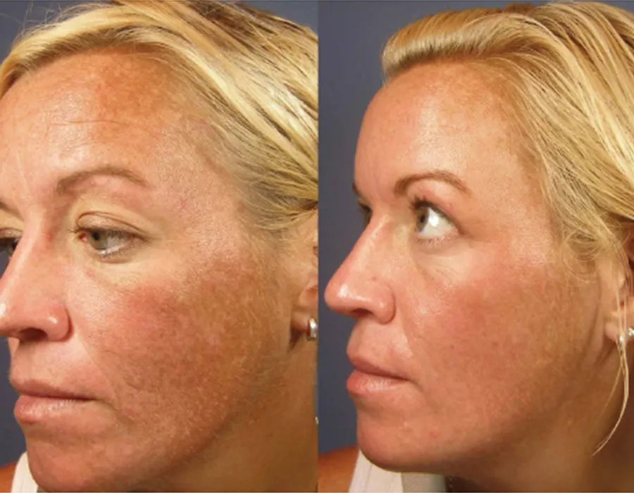 Light skin VI Peel results before and after at Skin Science Clinic in London