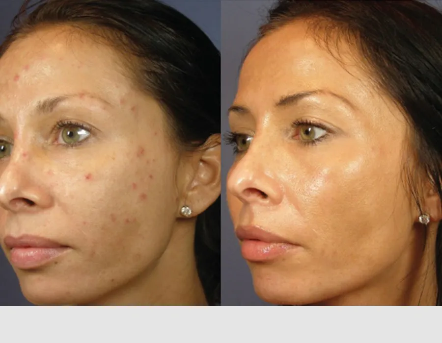 Results before and after a VI Peel at Skin Science Clinic London